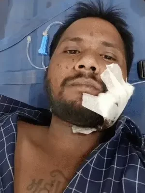 पारा में दांतों से काटा युवक का गाल, मांस निकला