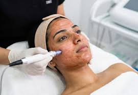 सेलेब्रिटीज की पहली पसंद बना Vampire Facial, जानिए कितना असरदार है यह ट्रीटमेंट