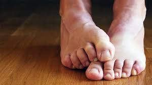 Fungal Infection in Foot: पैरों से आती है लगातार बदबू? कहीं यह फंगल इंफेक्शन का संकेत तो नहीं